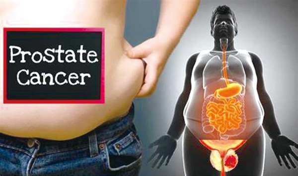 一项大规模新研究表明肥胖与前列腺癌死亡风险增加有关