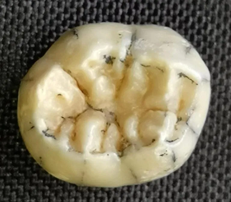Ngu-Hao-2-Tooth-768x672.webp